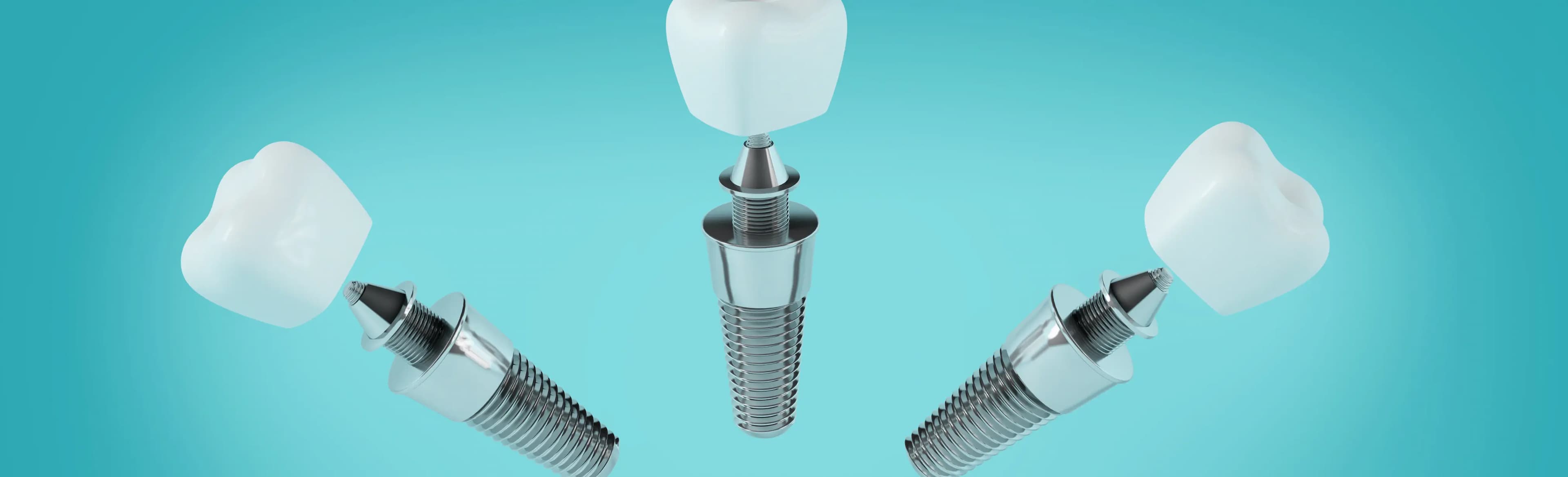 Figuring out Dental Implants Price