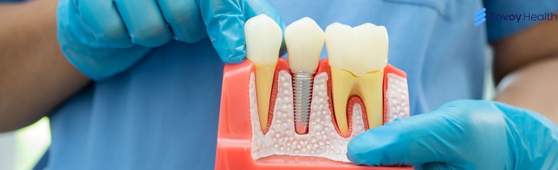 Everything You Need To Know About All-on-4 Dental Implants Algodones, Mexico