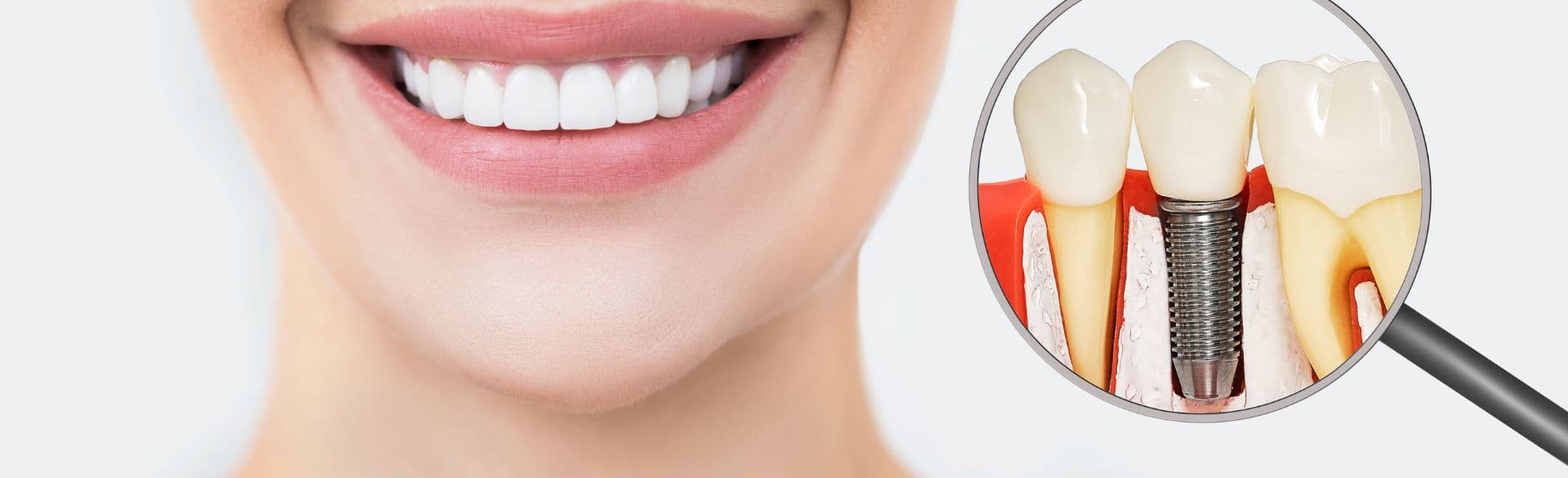 How Teeth and Implants Work Together for a Healthy Smile