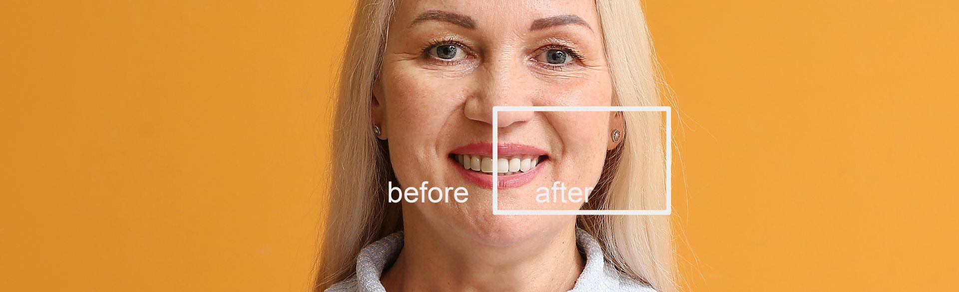 Smile Makeover in Mexico Smile Makeover in Mexico