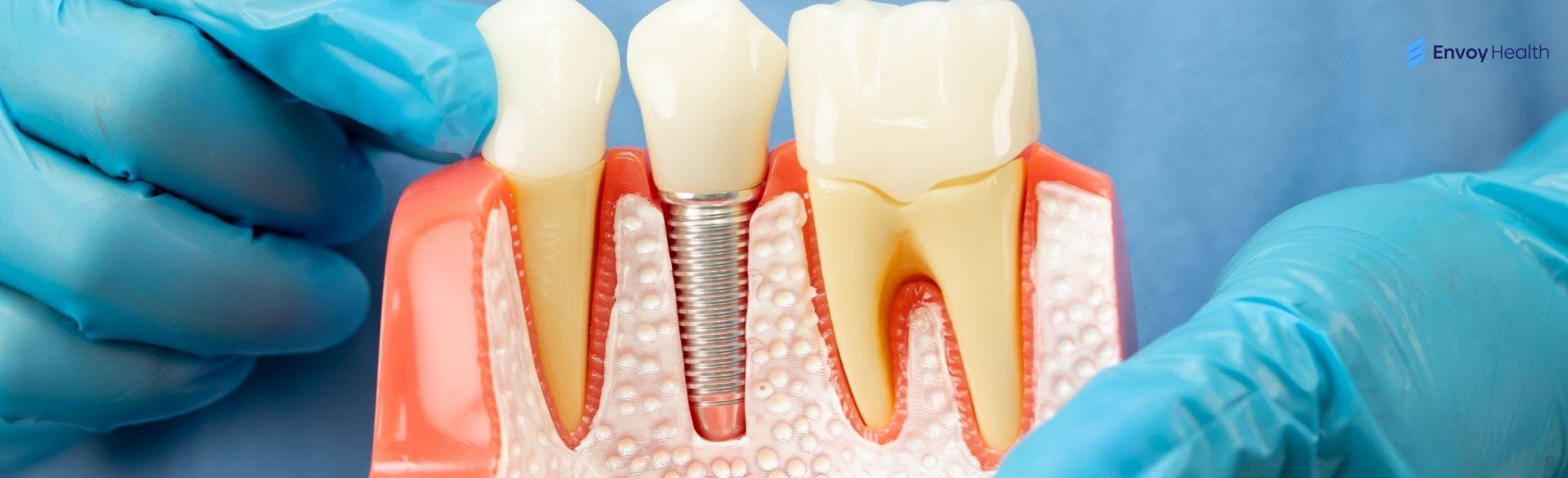 What is teeth implants made of What is teeth implants made of