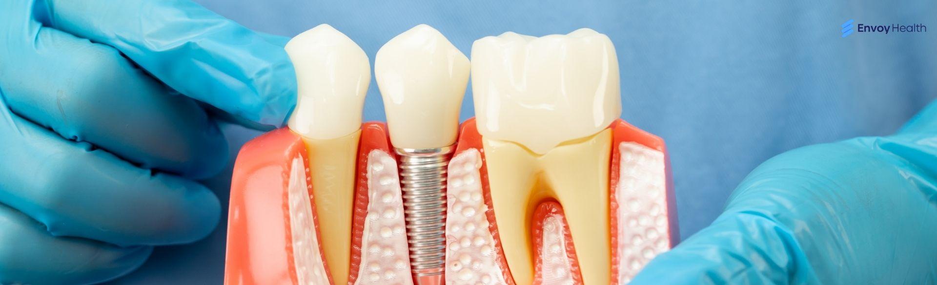 What dental insurance covers implants the best What dental insurance covers implants the best