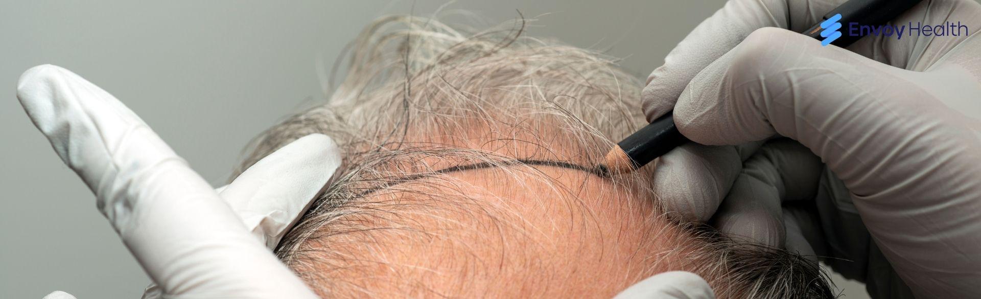 What You Should Know About Hair Transplant Turkey? What You Should Know About Hair Transplant Turkey?