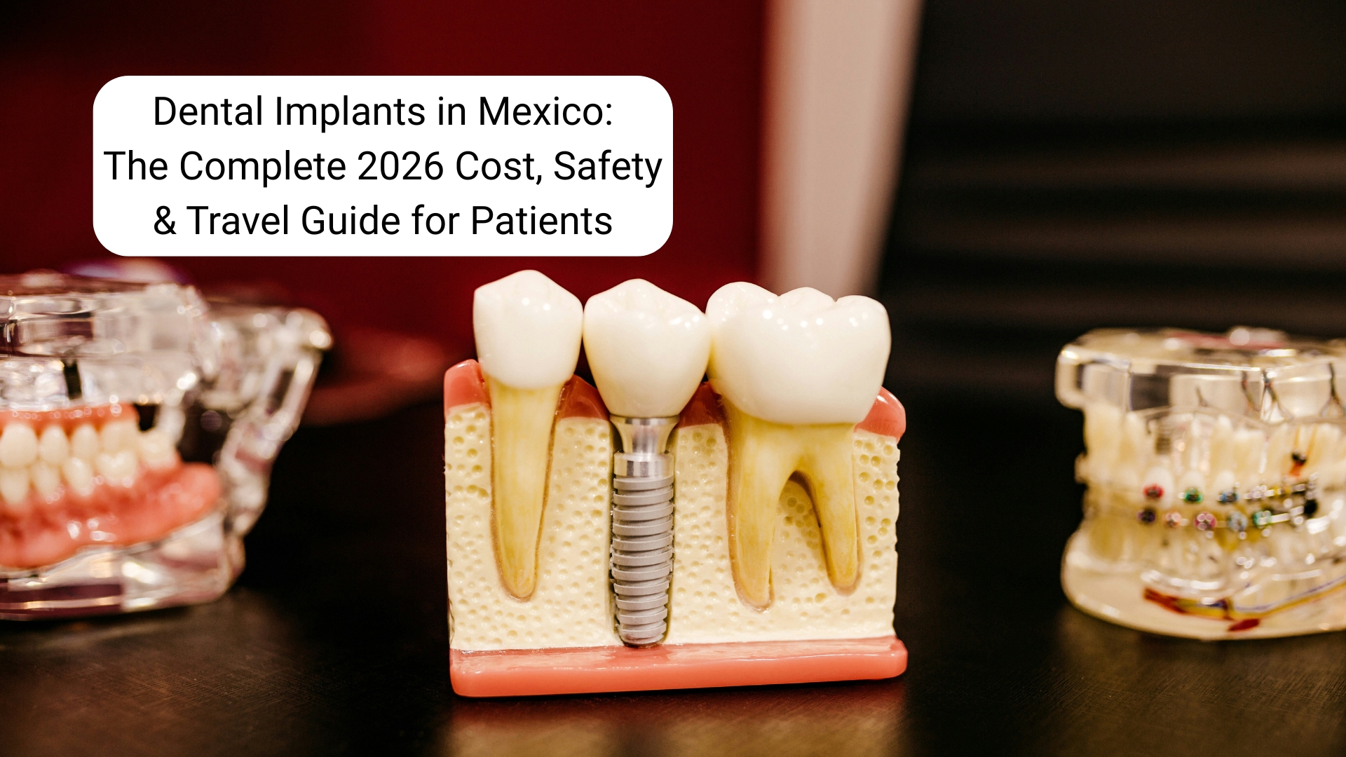 Dental Implants in Mexico Dental Implants in Mexico: The Complete 2026 Cost, Safety & Travel Guide for US Patients